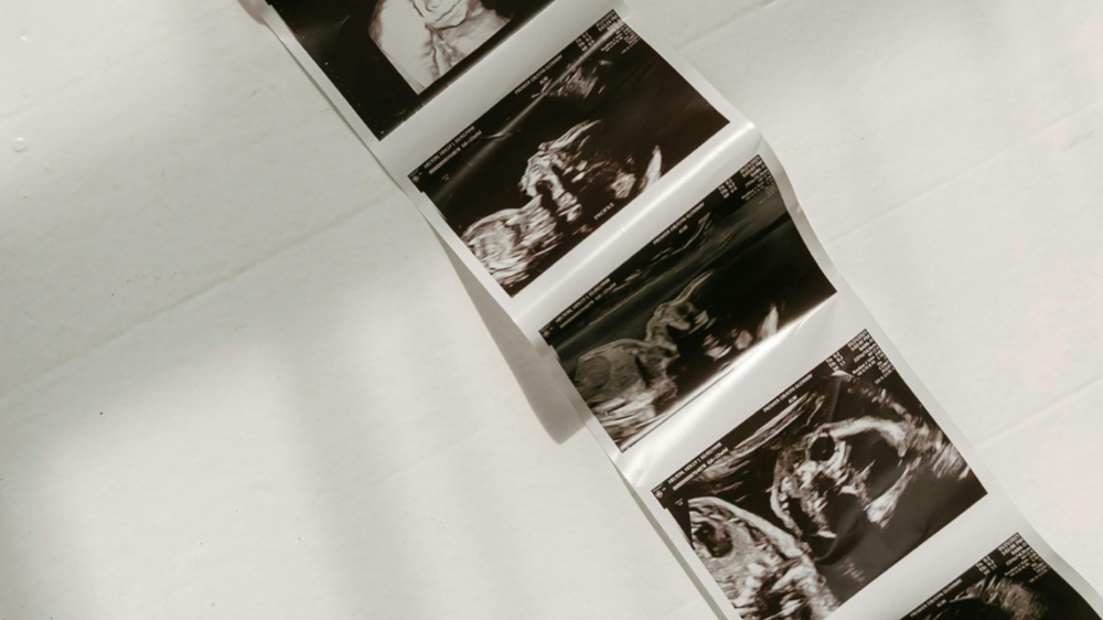 【保存版】エコー写真の保存方法｜消えない・色褪せない残し方を解説【ダイソー・無印・100均・アプリ活用術】：エコー写真は本当に消える？色褪せる原因と保存前に知っておきたいこと